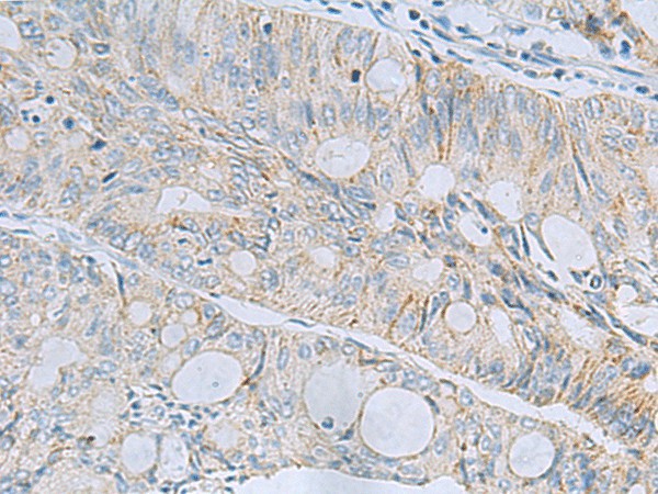 Immunohistochemistry of paraffin-embedded Human colorectal cancer tissue  using MSI2 Polyclonal Antibody at dilution of 1:60(?200)