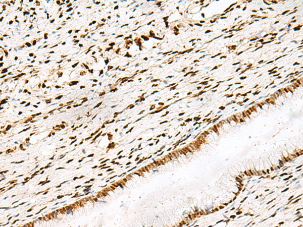 Immunohistochemistry of paraffin-embedded Human cervical cancer tissue  using DNPEP Polyclonal Antibody at dilution of 1:30(?200)