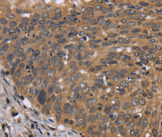 Immunohistochemistry of paraffin-embedded Human cervical cancer using FGFR1OP Polyclonal Antibody at dilution of 1:40