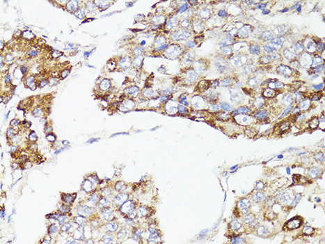 Immunohistochemistry of paraffin-embedded Human liver cancer using mTOR Polyclonal Antibody at dilution of 1:150 (40x lens).