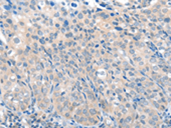 Immunohistochemistry of paraffin-embedded Human cervical cancer tissue  using SLC17A6 Polyclonal Antibody at dilution of 1:100(?200)