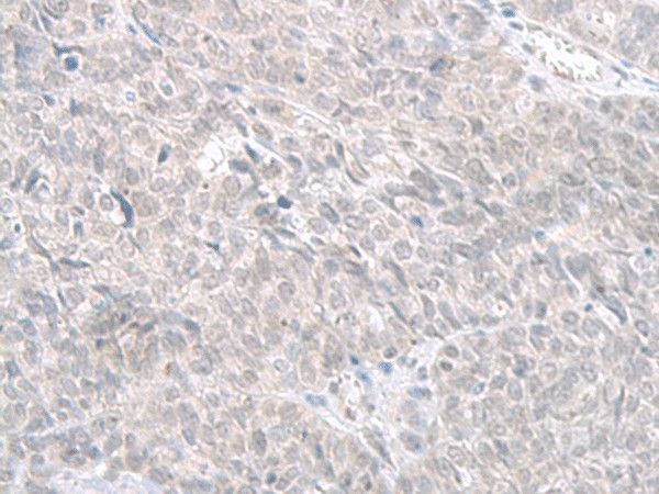 Immunohistochemistry of paraffin-embedded Human ovarian cancer tissue  using STAU2 Polyclonal Antibody at dilution of 1:60(?200)