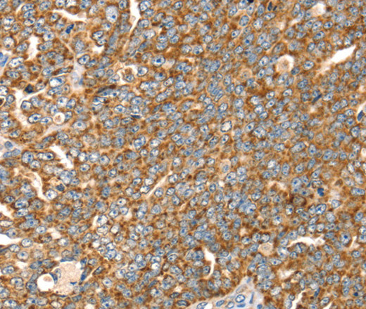 Immunohistochemistry of paraffin-embedded Human cervical cancer tissue using SLC8A3 Polyclonal Antibody at dilution 1:35