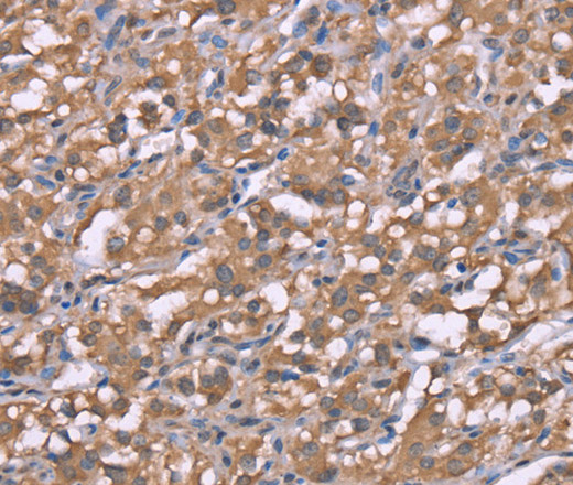 Immunohistochemistry of paraffin-embedded Human thyroid cancer using Histamine H3 Receptor Polyclonal Antibody at dilution of 1:50