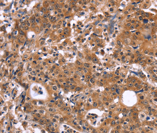 Immunohistochemistry of paraffin-embedded Human gastric cancer tissue using HACE1 Polyclonal Antibody at dilution 1:40