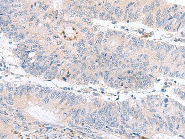 Immunohistochemistry of paraffin-embedded Human colorectal cancer tissue  using PDE6D Polyclonal Antibody at dilution of 1:60(?200)