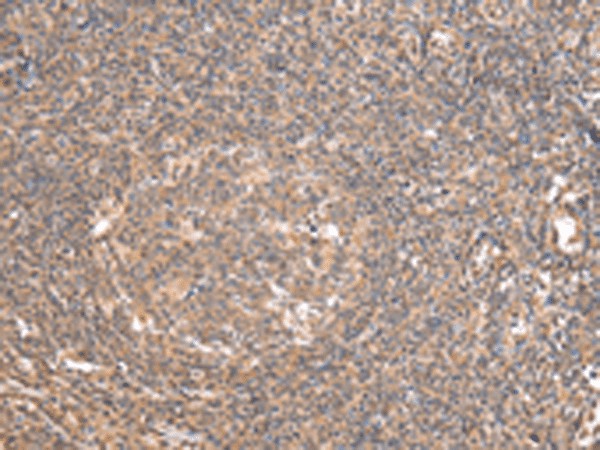 Immunohistochemistry of paraffin-embedded Human tonsil tissue  using DDX58 Polyclonal Antibody at dilution of 1:35(?200)