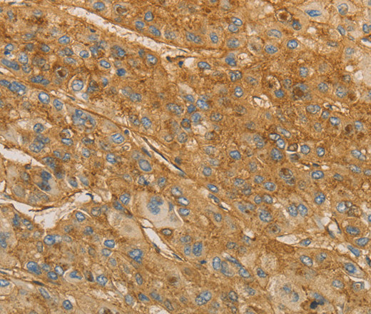 Immunohistochemistry of paraffin-embedded Human liver cancer tissue using VTN Polyclonal Antibody at dilution 1:40