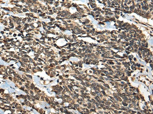 Immunohistochemistry of paraffin-embedded Human lung cancer tissue  using MICU1 Polyclonal Antibody at dilution of 1:35(?200)