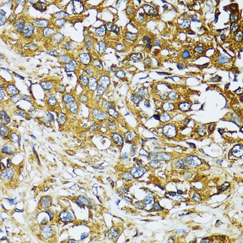 Immunohistochemistry of paraffin-embedded Human liver cancer using ATG7 Polyclonal Antibody at dilution of 1:100 (40x lens).