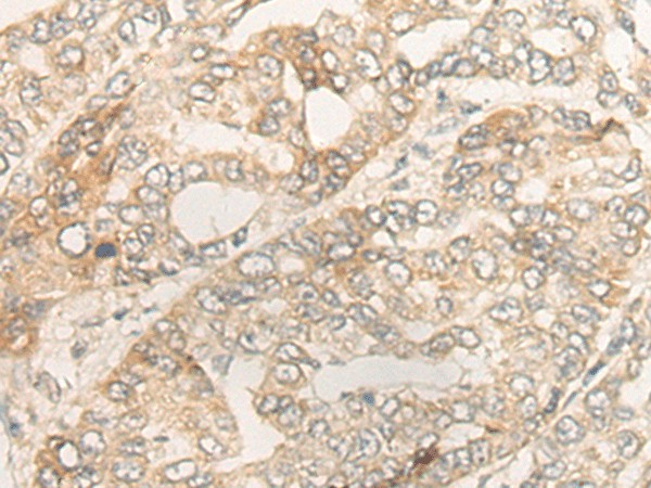 Immunohistochemistry of paraffin-embedded Human liver cancer tissue  using DUOX2 Polyclonal Antibody at dilution of 1:40(?200)