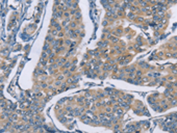 Immunohistochemistry of paraffin-embedded Human breast cancer tissue  using ZBTB1  Polyclonal Antibody at dilution of 1:50(?200)