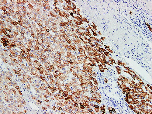 Immunohistochemistry of paraffinembedded Human liver cancer tissue with Cytokeratin 18 Monoclonal Antibody(Antigen repaired by EDTA).