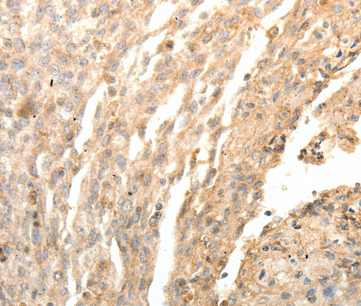 Immunohistochemistry of paraffin-embedded Human cervical cancer tissue using SFTPD Polyclonal Antibody at dilution 1:30