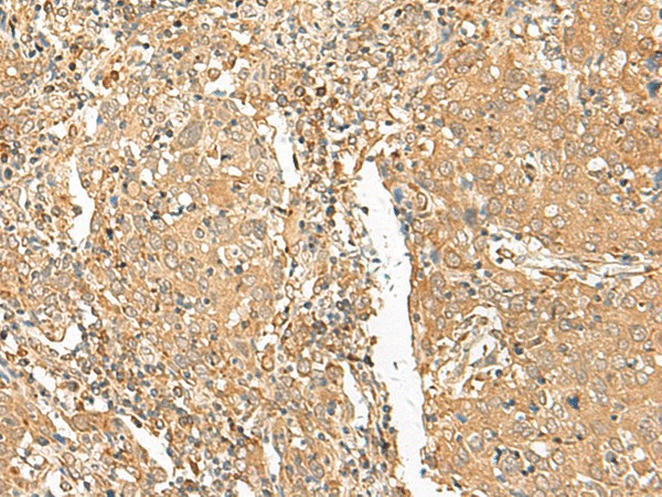 Immunohistochemistry of paraffin-embedded Human cervical cancer tissue  using GOLGA6A Polyclonal Antibody at dilution of 1:50(?200)