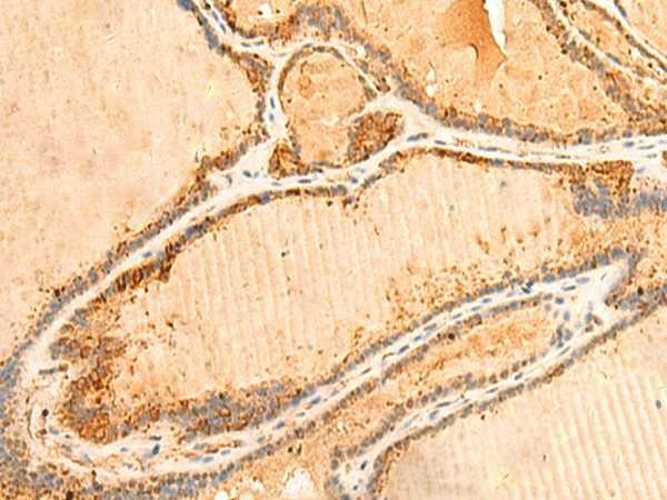 Immunohistochemistry of paraffin-embedded Human thyroid cancer tissue  using PPM1B Polyclonal Antibody at dilution of 1:50(?200)