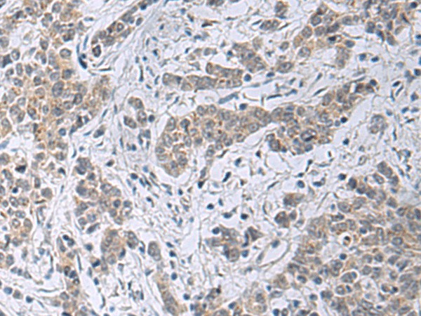 Immunohistochemistry of paraffin-embedded Human colorectal cancer tissue  using SLC4A3 Polyclonal Antibody at dilution of 1:35(?200)