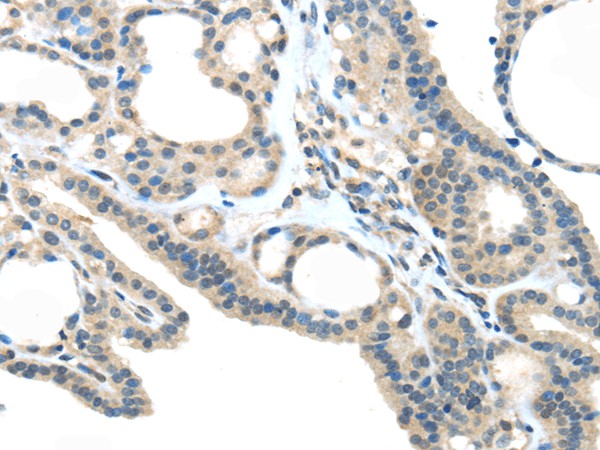 Immunohistochemistry of paraffin-embedded Human thyroid cancer tissue using VSIG10 Polyclonal Antibody at dilution 1:45