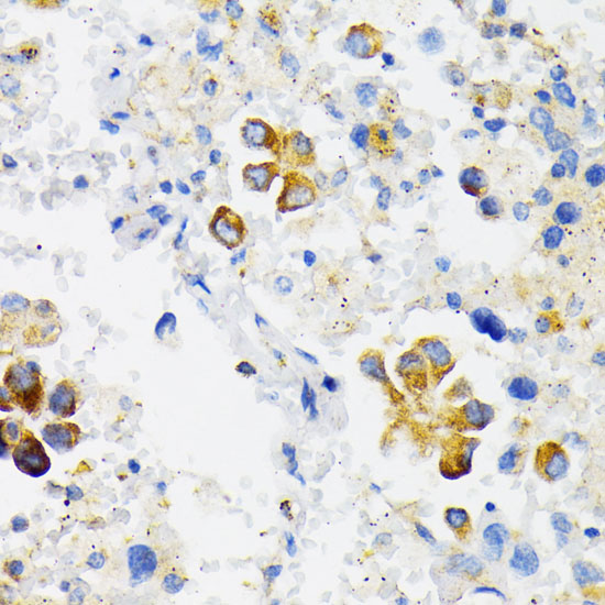 Immunohistochemistry of paraffin-embedded Human lung cancer using USO1 Polyclonal Antibody at dilution of 1:100 (40x lens).