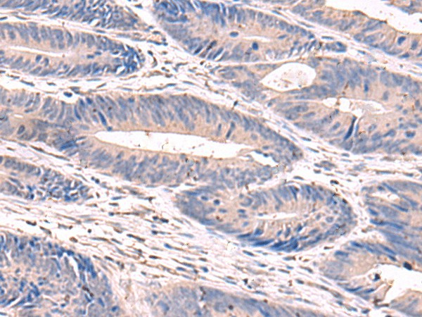 Immunohistochemistry of paraffin-embedded Human colorectal cancer tissue  using GKAP1 Polyclonal Antibody at dilution of 1:100(?200)