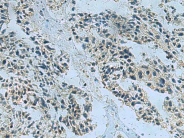 Immunohistochemistry of paraffin-embedded Human ovarian cancer tissue  using NDUFA2 Polyclonal Antibody at dilution of 1:40(?200)