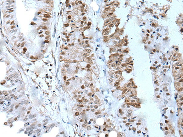 Immunohistochemistry of paraffin-embedded Human liver cancer tissue  using ZNHIT3 Polyclonal Antibody at dilution of 1:80(?200)