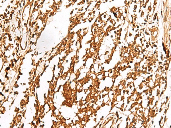 Immunohistochemistry of paraffin-embedded Human lung cancer tissue  using TERF1 Polyclonal Antibody at dilution of 1:30(?200)