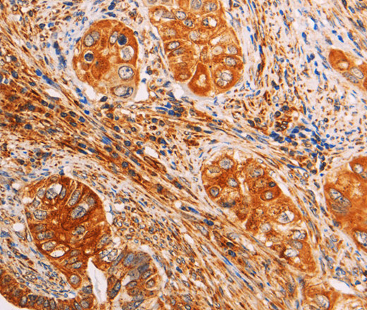 Immunohistochemistry of paraffin-embedded Human cervical cancer using SLC25A4 Polyclonal Antibody at dilution of 1:40