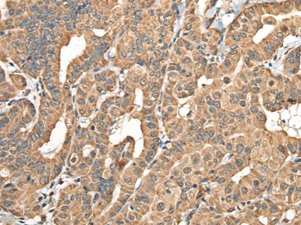 Immunohistochemistry of paraffin-embedded Human thyroid cancer tissue  using NADK2 Polyclonal Antibody at dilution of 1:40(?200)