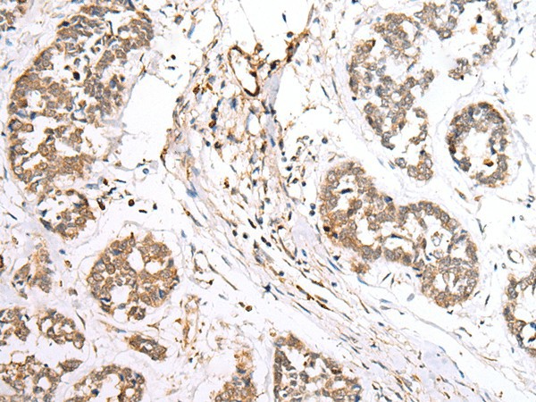 Immunohistochemistry of paraffin-embedded Human esophagus cancer tissue  using BAG2 Polyclonal Antibody at dilution of 1:40(?200)