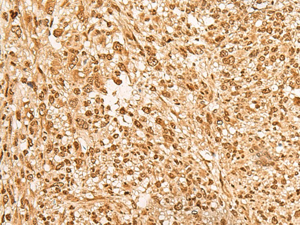 Immunohistochemistry of paraffin-embedded Human liver cancer tissue  using JPT2 Polyclonal Antibody at dilution of 1:65(?200)