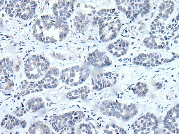 Immunohistochemistry of paraffin-embedded Human esophagus cancer tissue  using RARG Polyclonal Antibody at dilution of 1:55(?200)