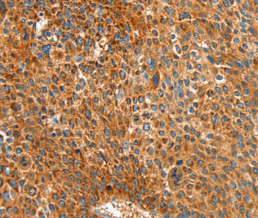 Immunohistochemistry of paraffin-embedded Human liver cancer tissue using ALDH1A2 Polyclonal Antibody at dilution 1:30