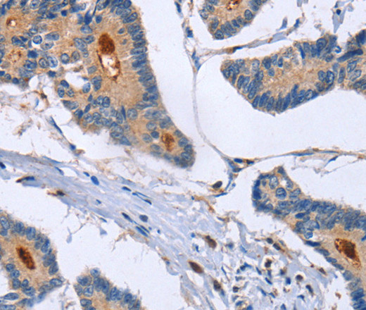 Immunohistochemistry of paraffin-embedded Human colon cancer using GMFG Polyclonal Antibody at dilution of 1:50