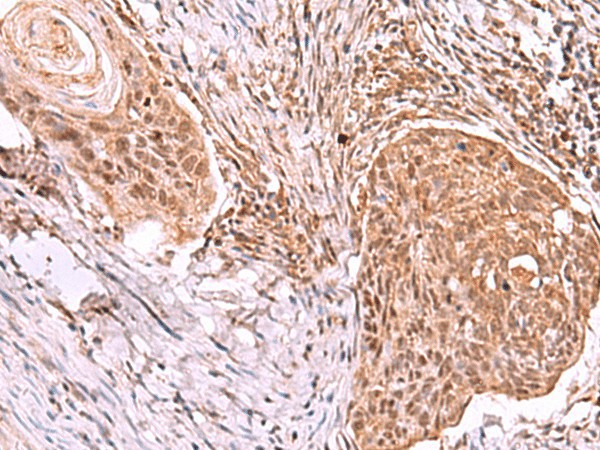 Immunohistochemistry of paraffin-embedded Human esophagus cancer tissue  using IRX4 Polyclonal Antibody at dilution of 1:40(?200)