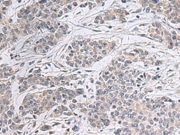 Immunohistochemistry of paraffin-embedded Human colorectal cancer tissue  using PPM1K Polyclonal Antibody at dilution of 1:55(?200)