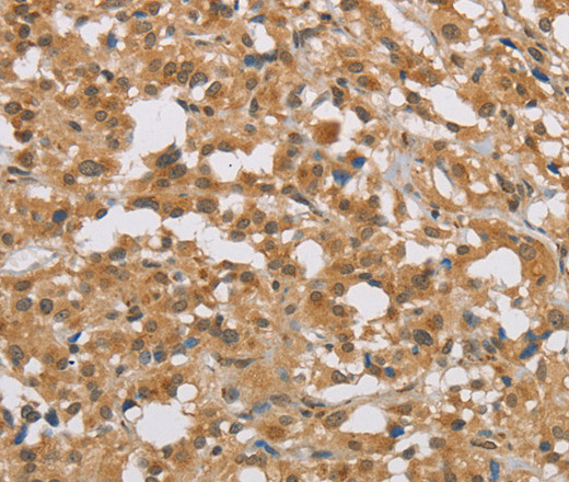 Immunohistochemistry of paraffin-embedded Human thyroid cancer tissue using DIO1 Polyclonal Antibody at dilution 1:50