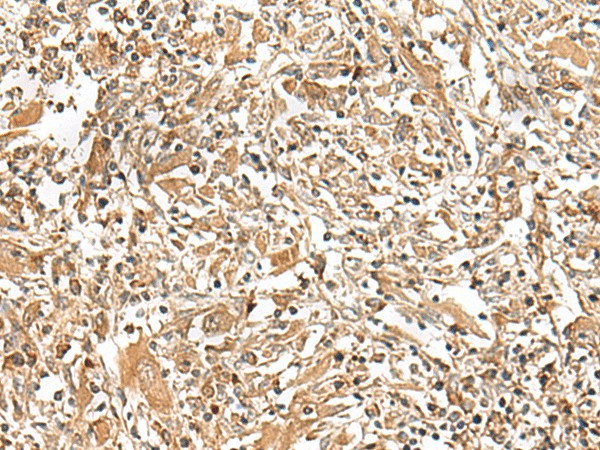 Immunohistochemistry of paraffin-embedded Human liver cancer tissue  using GEMIN4 Polyclonal Antibody at dilution of 1:30(?200)