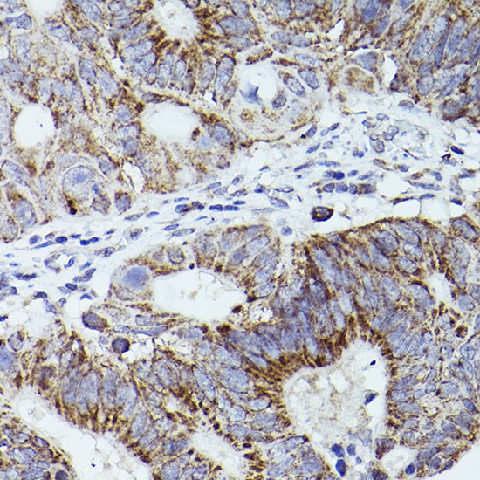 Immunohistochemistry of paraffin-embedded human colon carcinoma using THBS1 Polyclonal Antibody at dilution of 1:50 (40x lens).Perform high pressure antigen retrieval with 10 mM citrate buffer pH 6.0 before commencing with IHC staining protocol.