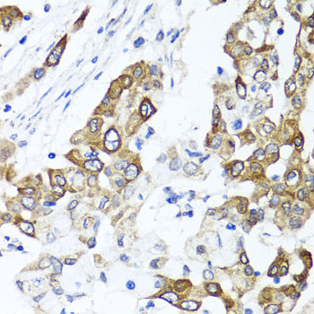 Immunohistochemistry of paraffin-embedded human colon carcinoma using PPOX Polyclonal Antibody at dilution of 1:100 (40x lens).Perform microwave antigen retrieval with 10 mM PBS buffer pH 7.2 before commencing with IHC staining protocol.