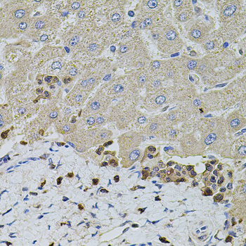 Immunohistochemistry of paraffin-embedded Human liver damage using S100A12 Polyclonal Antibody at dilution of  1:100 (40x lens).