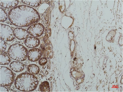 Immunohistochemistry of paraffin-embedded Human colon carcinoma tissue using HSPA5 Monoclonal Antibody at dilution of 1:200.