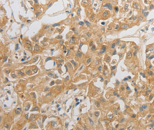 Immunohistochemistry of paraffin-embedded Human lung cancer tissue using HCRTR2 Polyclonal Antibody at dilution 1:50