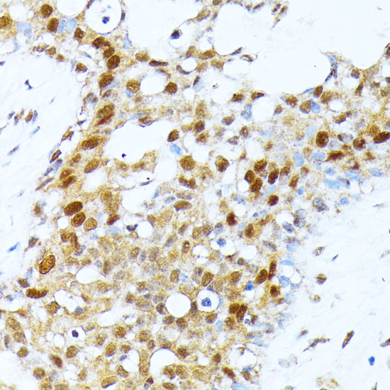 Immunohistochemistry of paraffin-embedded Human breast cancer using PRMT1 Polyclonal Antibody at dilution of  1:100 (40x lens).