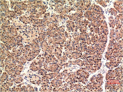 Immunohistochemistry of paraffin-embedded Human pancreas carcinoma tissue using CHOP Monoclonal Antibody at dilution of 1:200.