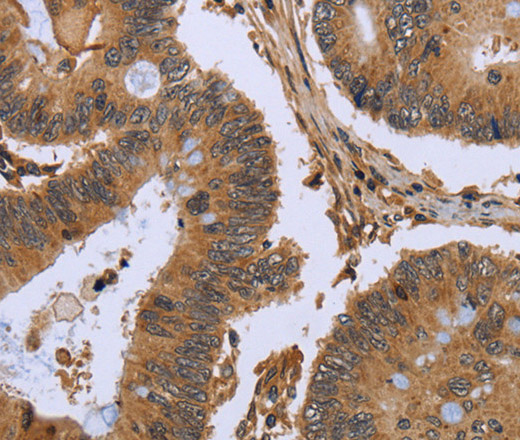 Immunohistochemistry of paraffin-embedded Human colon cancer using FHL2 Polyclonal Antibody at dilution of 1:50