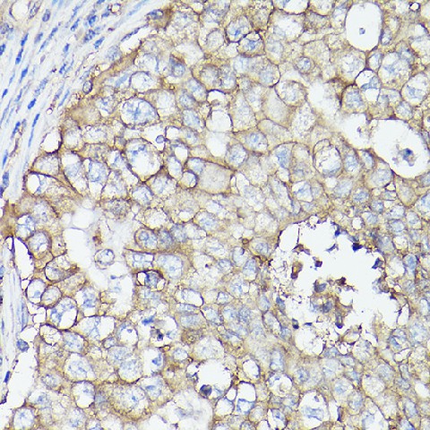 Immunohistochemistry of paraffin-embedded human breast cancer using MCT4/SLC16A3 Polyclonal Antibody at dilution of 1:100 (40x lens).Perform high pressure antigen retrieval with 10 mM citrate buffer pH 6.0 before commencing with IHC staining protocol.