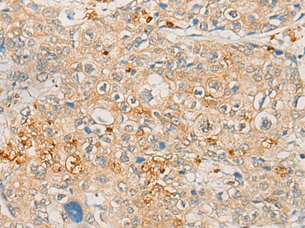 Immunohistochemistry of paraffin-embedded Human prost ate cancer tissue  using FBXO32 Polyclonal Antibody at dilution of 1:45(?200)