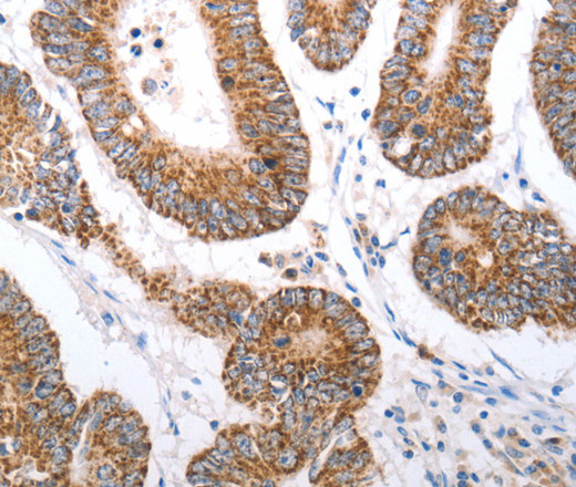 Immunohistochemistry of paraffin-embedded Human colon cancer tissue using HCRTR1 Polyclonal Antibody at dilution 1:70