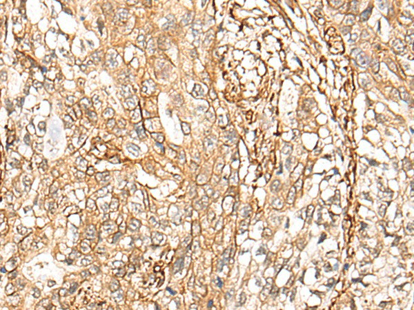 Immunohistochemistry of paraffin-embedded Human gastric cancer tissue  using CD99 Polyclonal Antibody at dilution of 1:40(?200)